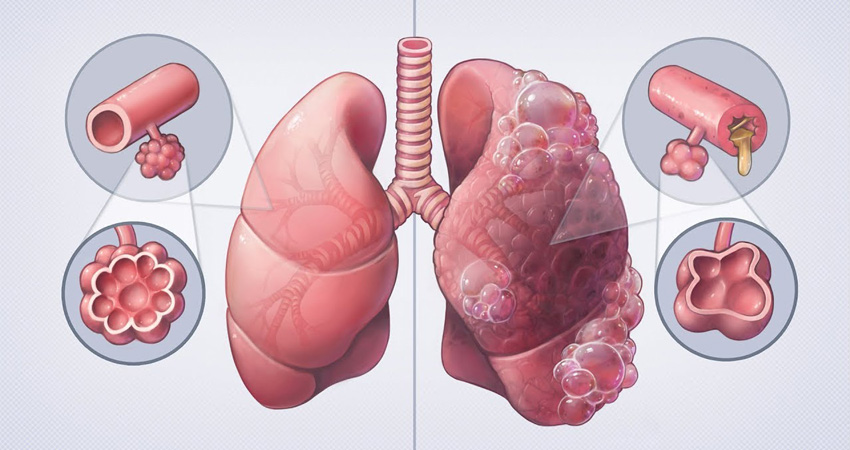 Факторы риска развития хронической обструктивной болезни лёгких